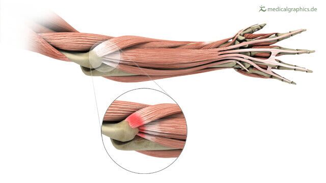 how much bac water to add to 500mg nad+ Autologous platelet-rich plasma injection in tennis elbow: Louis Peter Re,  Jr., MD main image 1